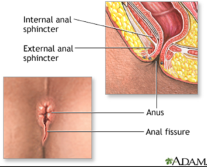 Medical illustration of Anal Fissure